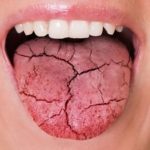 Dry Mouth: Causes, Symptoms, and Relief