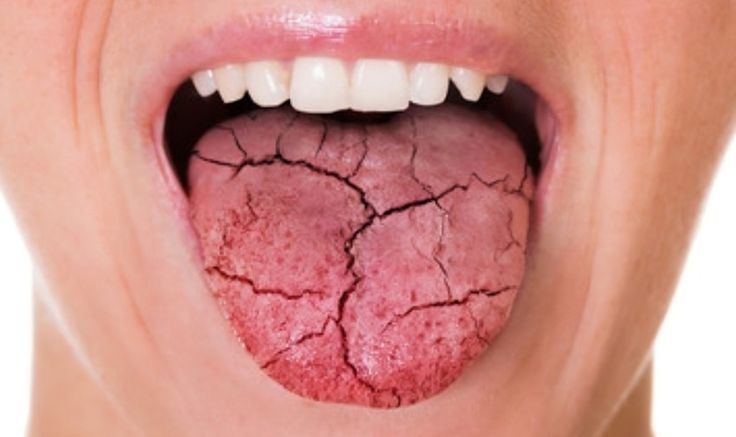 Xerostomia sign and symptoms