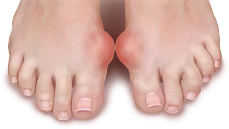 a leg with gout arthrities