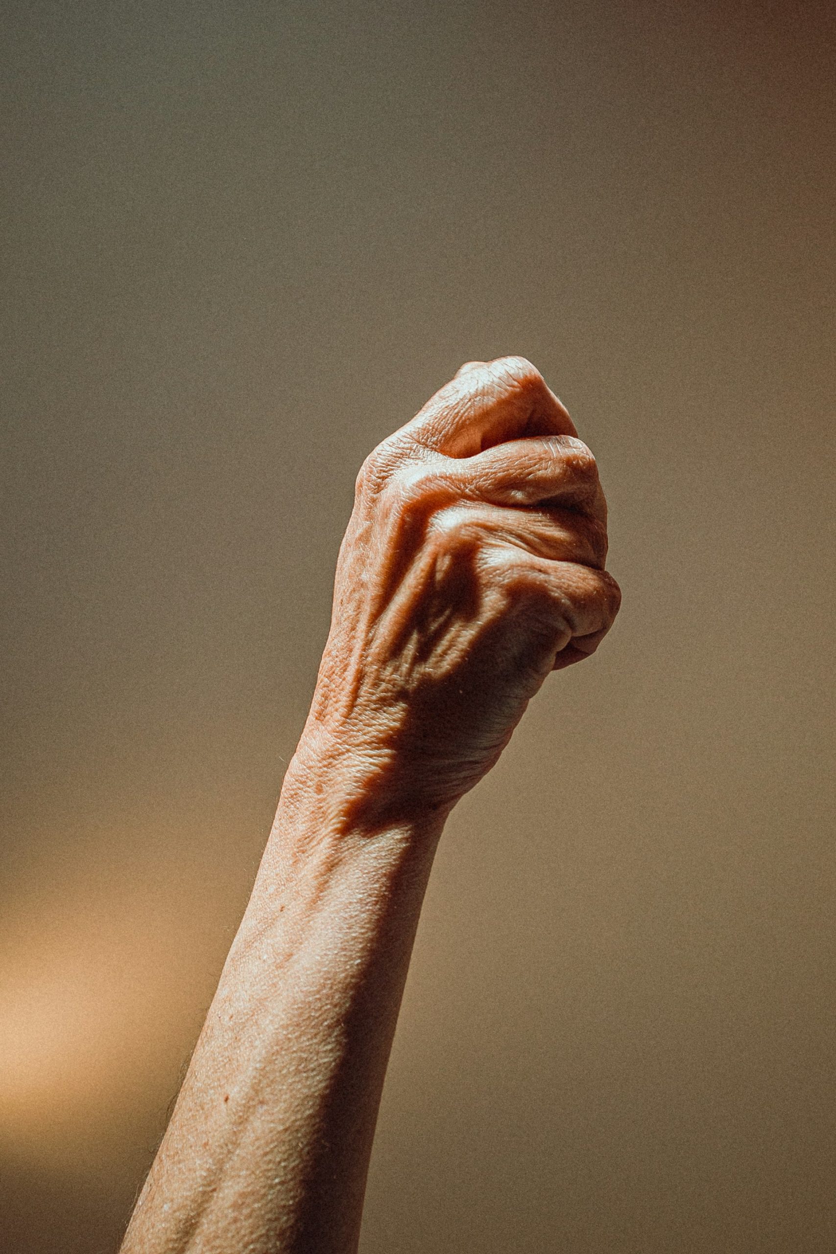Psoriatic Arthritis patient