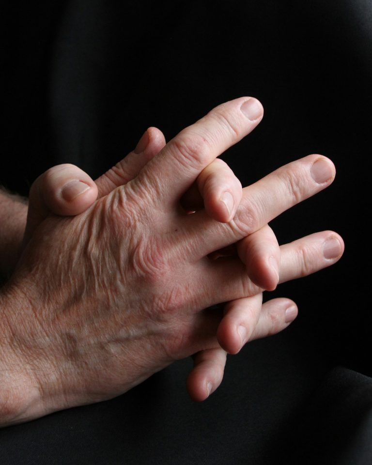 Rheumatoid Arthritis patient