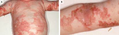zinc deficiency
