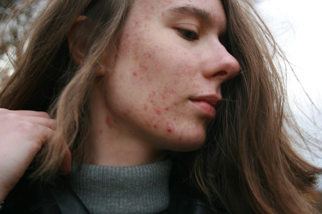 Understanding Acne: Causes, Types, and Effective Treatments