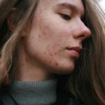 Understanding Acne: Causes, Types, and Effective Treatments