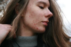 woman with acne face