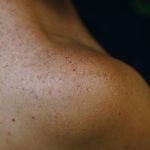 Eczema Explained: Causes, Symptoms, and Effective Treatments