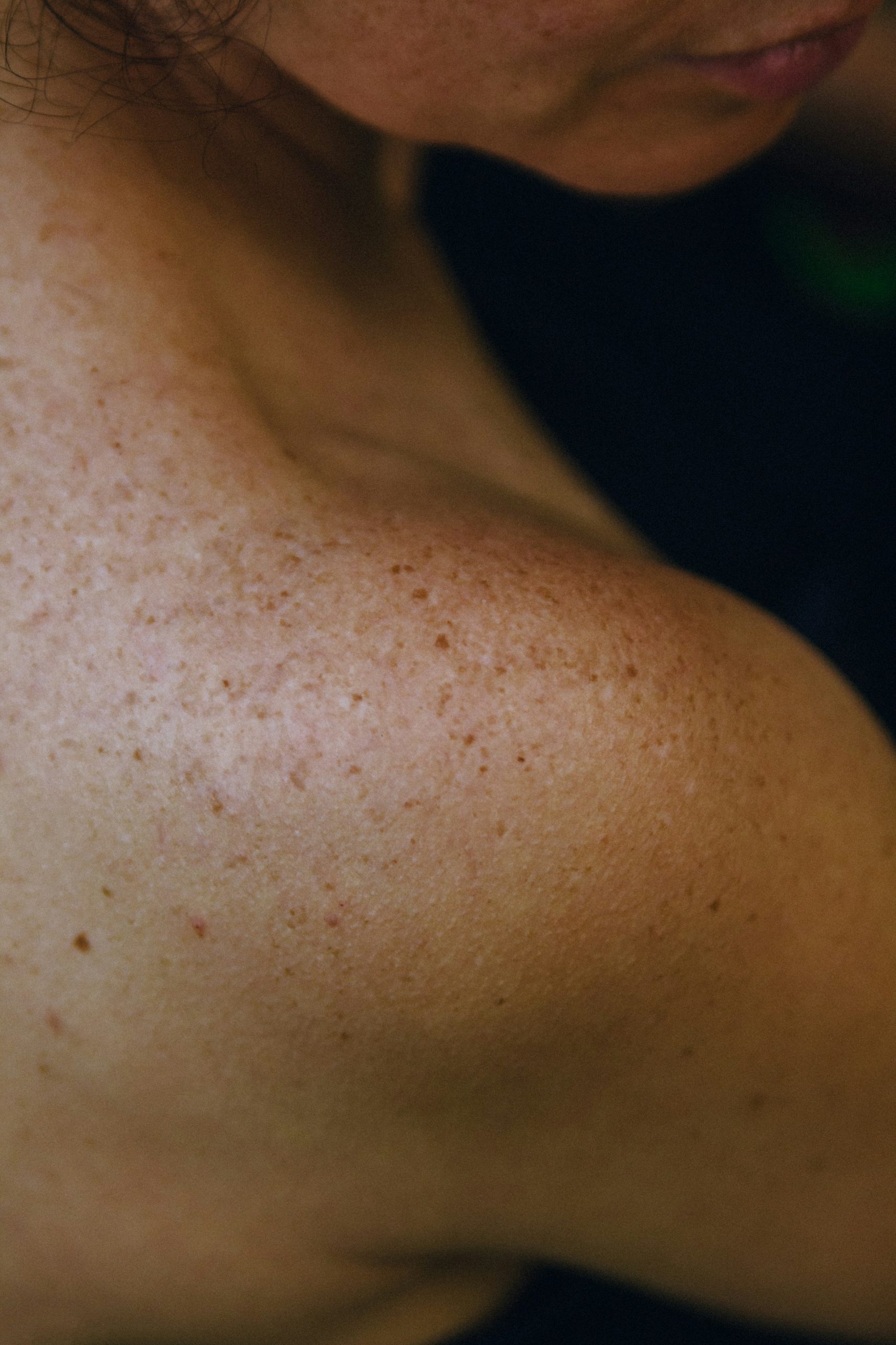 an eczema patient