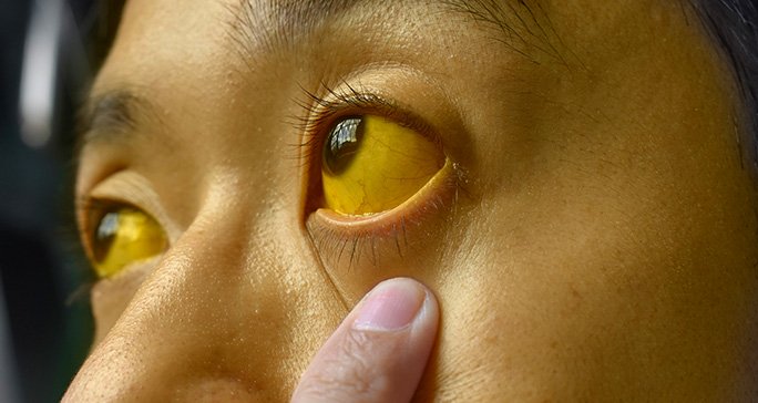 person with yellow eyes and skin