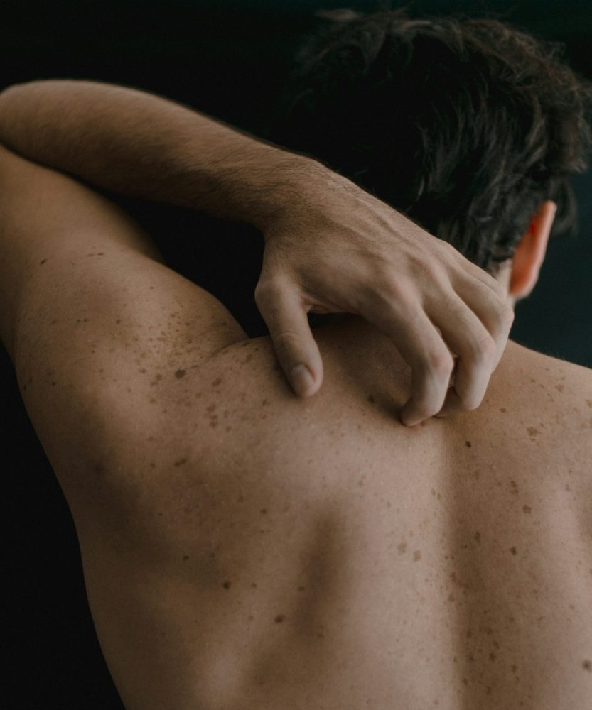 psoriasis patient