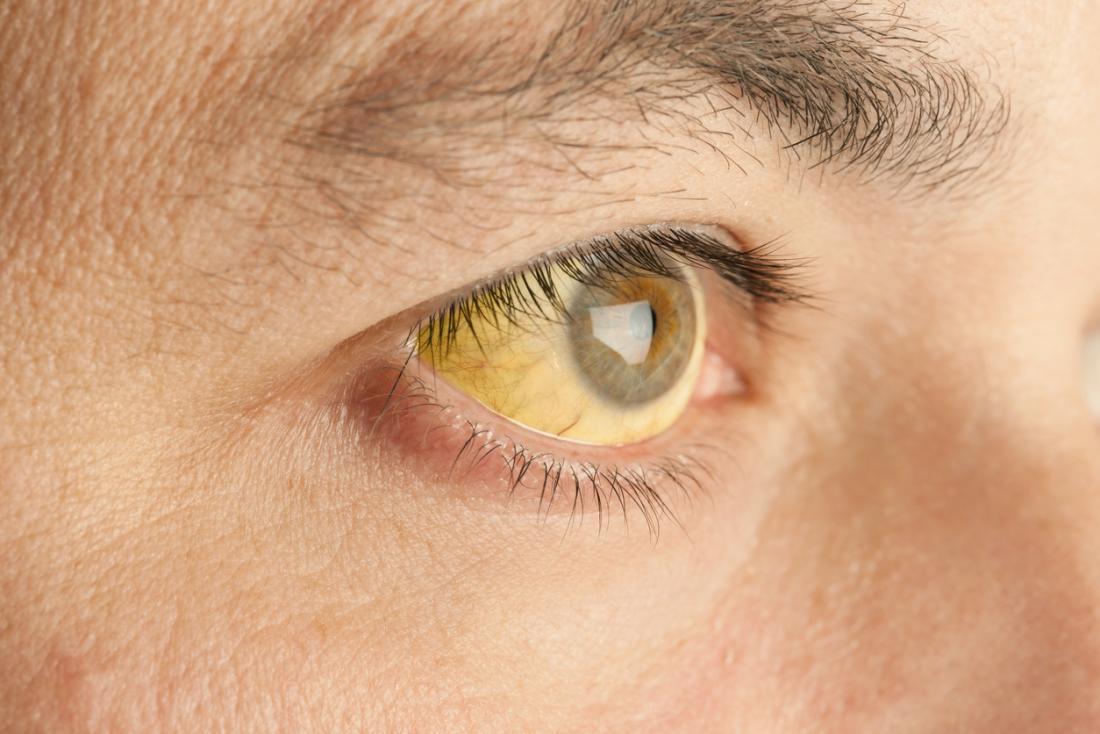 a man with yellow fever
