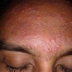 Acne: Causes, Symptoms, and Treatments