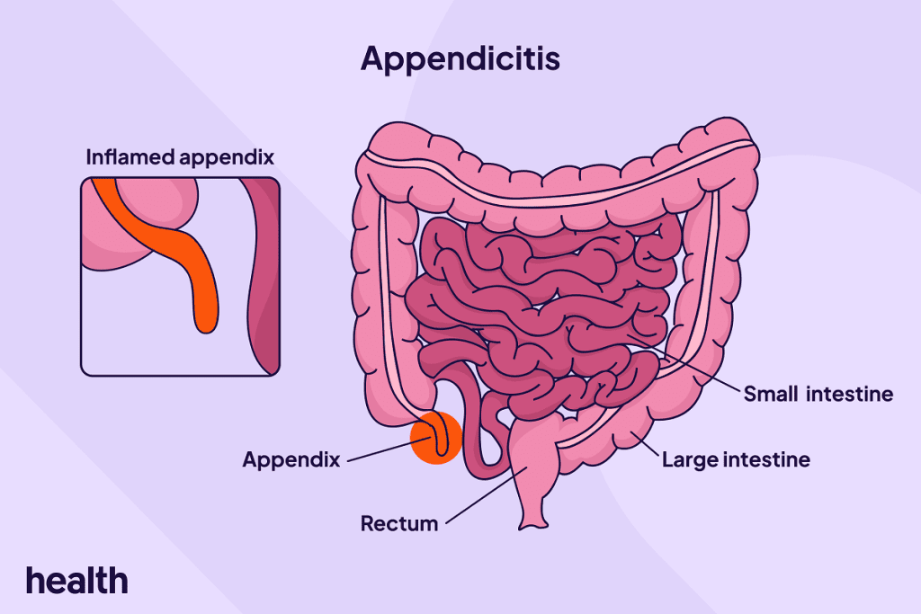 Appendicitis: When to Seek Emergency Help