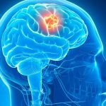Brain Tumor: Common Signs & Diagnostic Tools