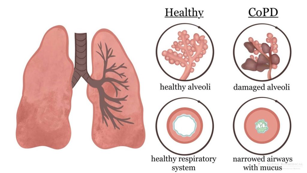 COPD: Breathing Better with Chronic Obstructive Pulmonary Disease