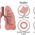 COPD: Breathing Better with Chronic Obstructive Pulmonary Disease