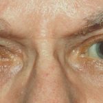 What You Need to Know About Glaucoma and Blindness