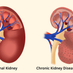 What Causes Kidney Stones? Symptoms and Risks