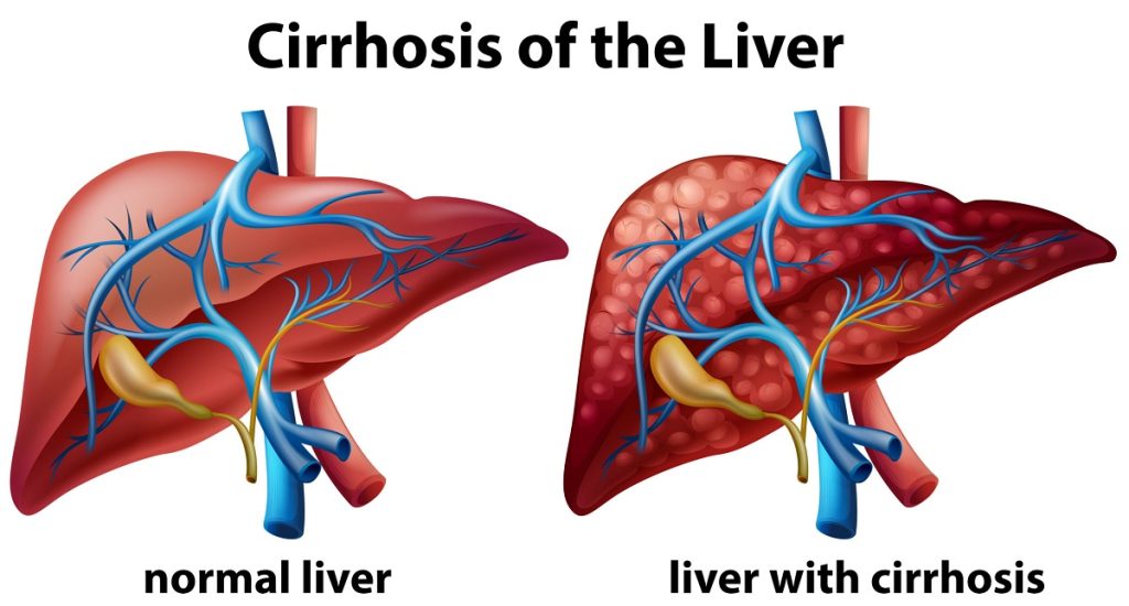 Cirrhosis: Liver Damage Explained and What You Should Do