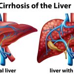 Cirrhosis: Liver Damage Explained and What You Should Do