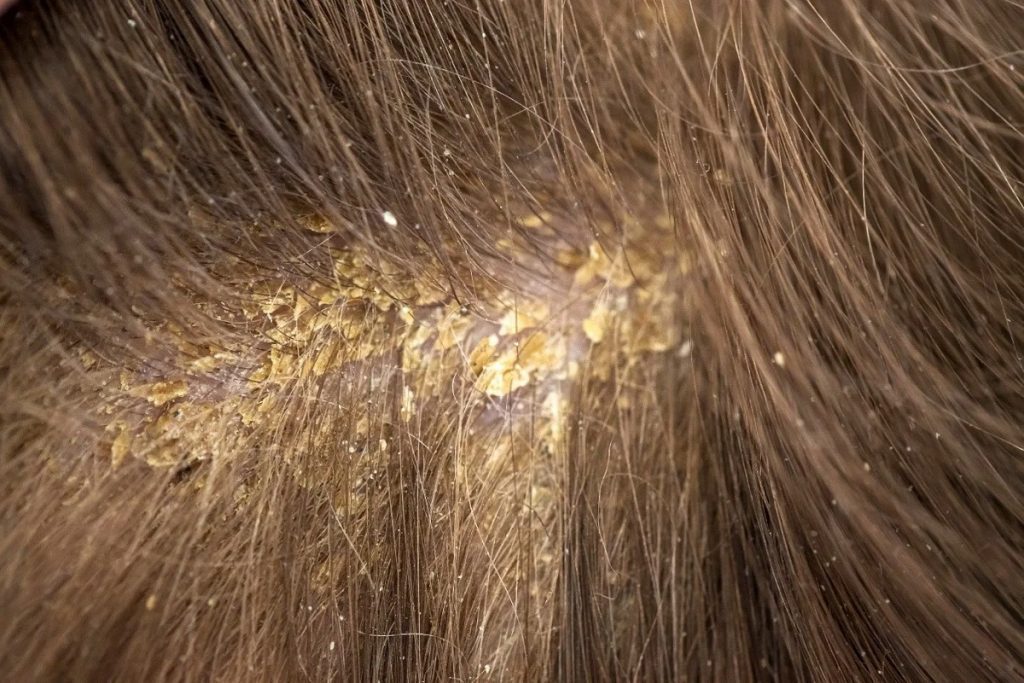 Dandruff: Causes and Treatments That Work