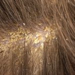 Dandruff: Causes and Treatments That Work