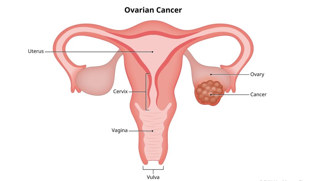 Understanding Ovarian Cancer: Symptoms and Treatment – Early Detection is Key