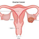 Understanding Ovarian Cancer: Symptoms and Treatment – Early Detection is Key