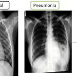 Pneumonia: Symptoms, Treatment, and Recovery Timeline