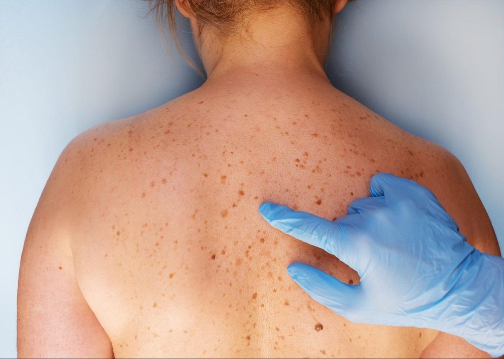 Skin Cancer: Warning Signs, Diagnosis, and Prevention