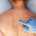 Skin Cancer: Warning Signs, Diagnosis, and Prevention