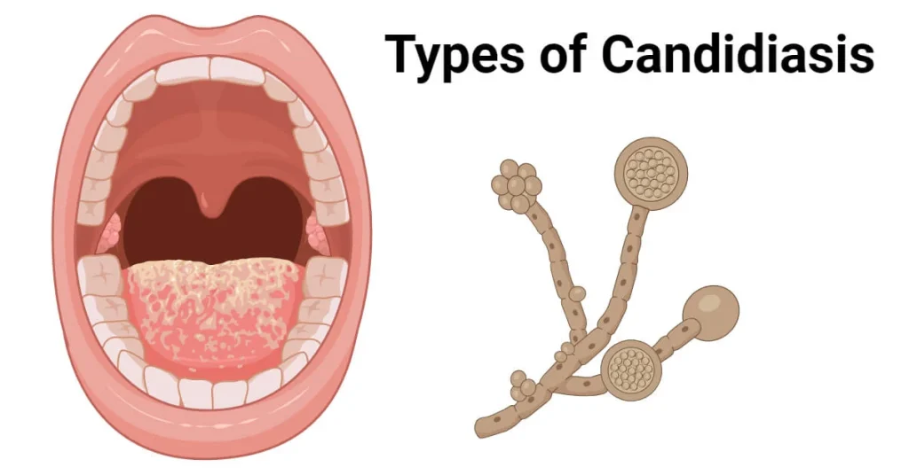 Candidiasis: Causes, Symptoms, and Treatment
