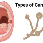 Candidiasis: Causes, Symptoms, and Treatment