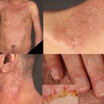 Mixed Connective Tissue Disease: Symptoms, Diagnosis, and Treatment