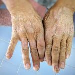 Understanding Scleroderma: What Causes Skin Tightening and Treatment Options