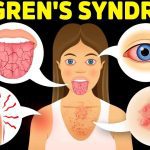 Sjögren’s Syndrome: Causes, Symptoms, and Treatment