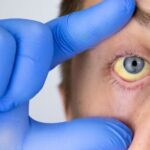 Anemia: Types, Causes, Symptoms & Effective Treatment Options