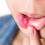 Canker Sores: Causes, Symptoms, Diagnosis, and Treatment Options