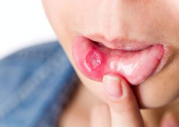 Canker Sores: Causes, Symptoms, Diagnosis, and Treatment Options