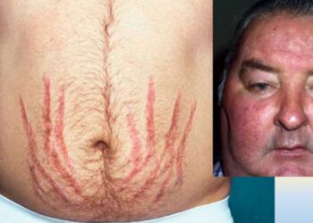 Cushing’s Syndrome: Causes, Symptoms, Diagnosis & Treatment Options