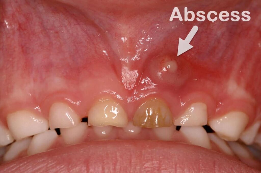 Dental Abscess: Causes, Symptoms, Diagnosis & Treatment Options