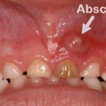 Dental Abscess: Causes, Symptoms, Diagnosis & Treatment Options