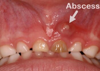 Dental Abscess: Causes, Symptoms, Diagnosis & Treatment Options