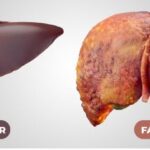 Fatty Liver Disease: Causes, Symptoms, and Treatments