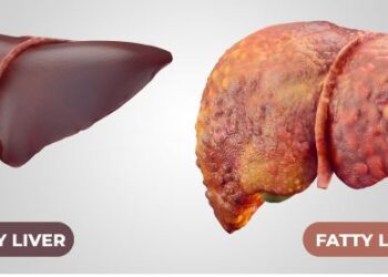 Fatty Liver Disease: Causes, Symptoms, and Treatments