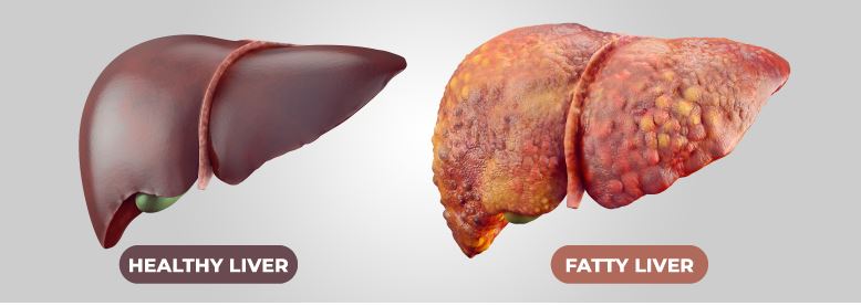 Fatty Liver Disease: Causes, Symptoms, and Treatments