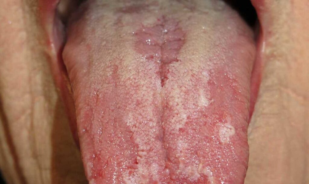 Glossitis: Causes, Symptoms, Diagnosis, and Treatment Options