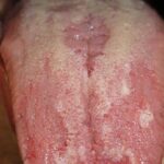 Glossitis: Causes, Symptoms, Diagnosis, and Treatment Options