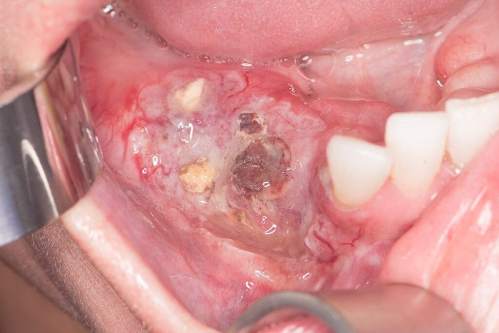 Dental Caries: Causes, Symptoms, Diagnosis and Treatment Options