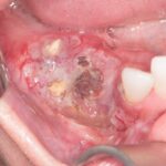 Dental Caries: Causes, Symptoms, Diagnosis and Treatment Options
