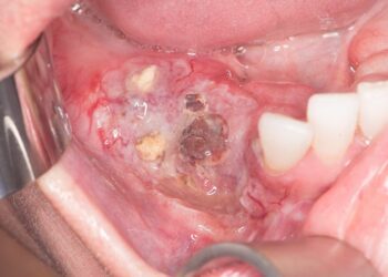 Oral Cancer: Causes, Symptoms, Diagnosis and Treatment Options